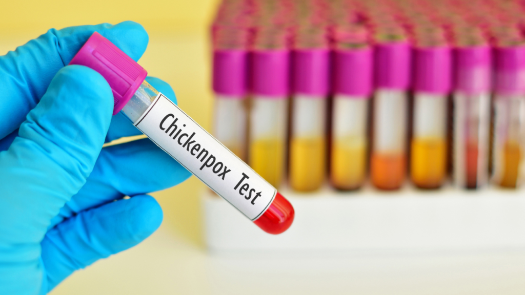 भारत में मिला Chickenpox का नया वेरिएंट Clade 9 :लक्षण, रोकथाम, और विवरण